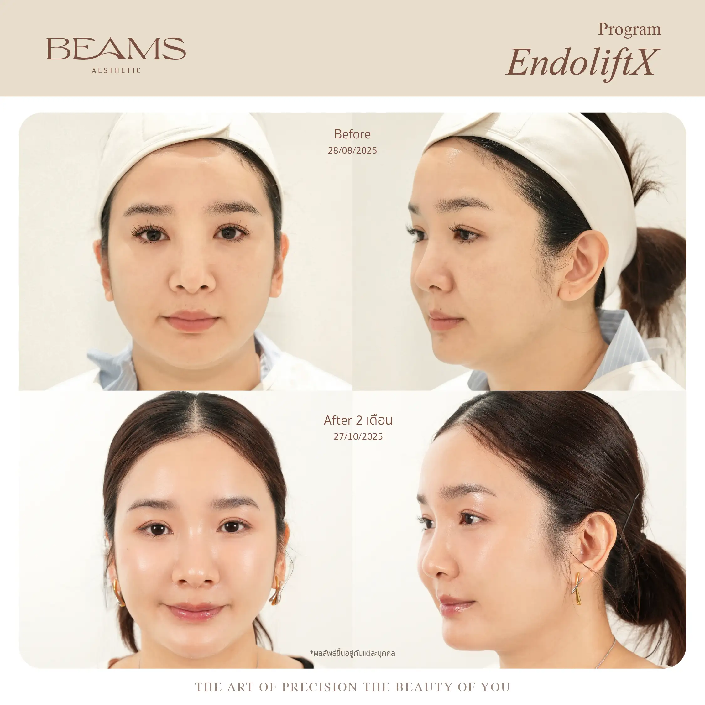 รีวิว Endolift