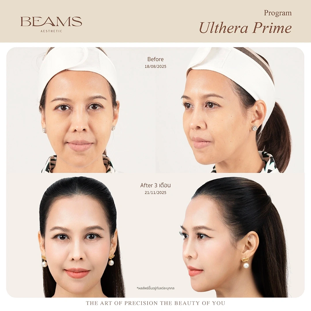 เคสรีวิว Endolift