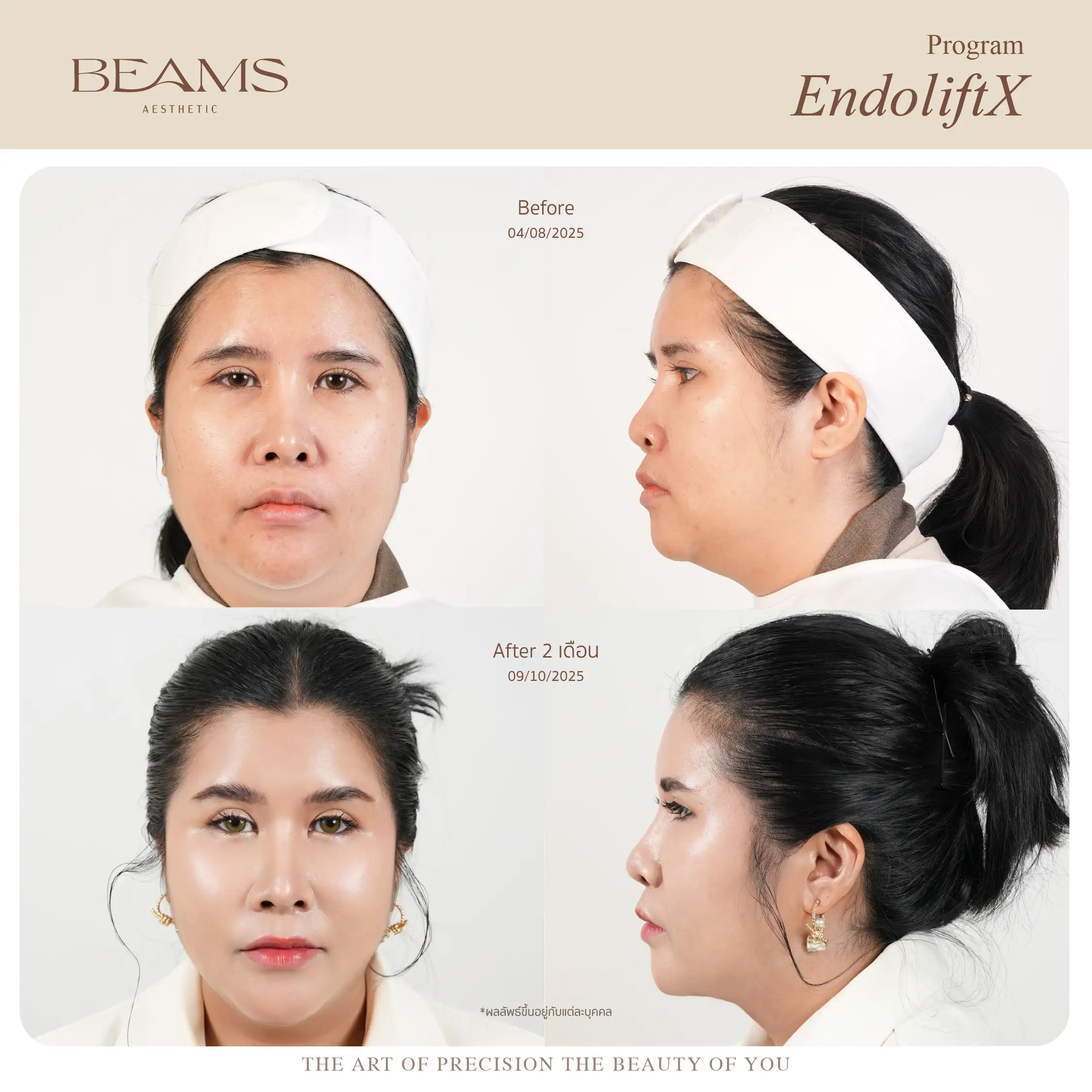 Review Endolift