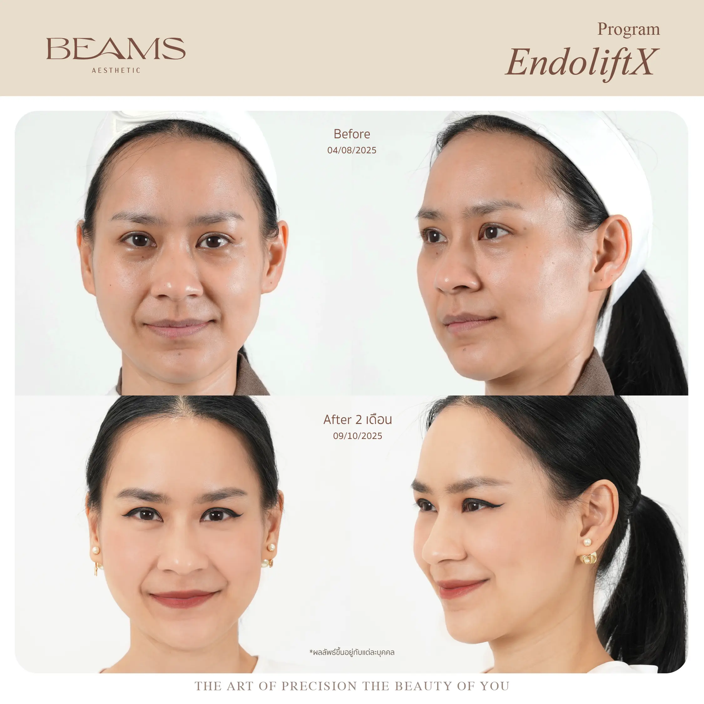 รีวิว Endolift