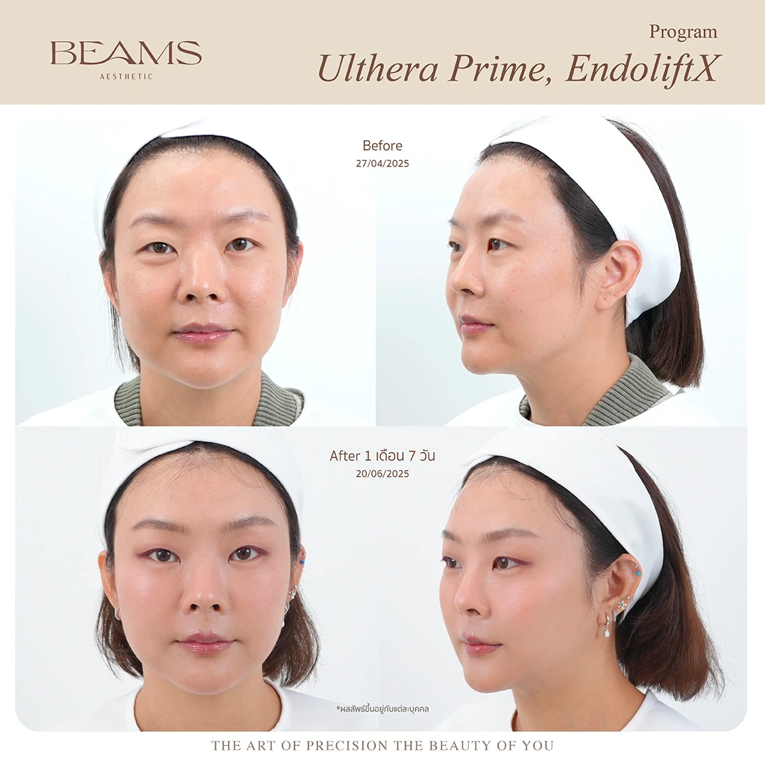 รีวิวหลังทำ Endolift