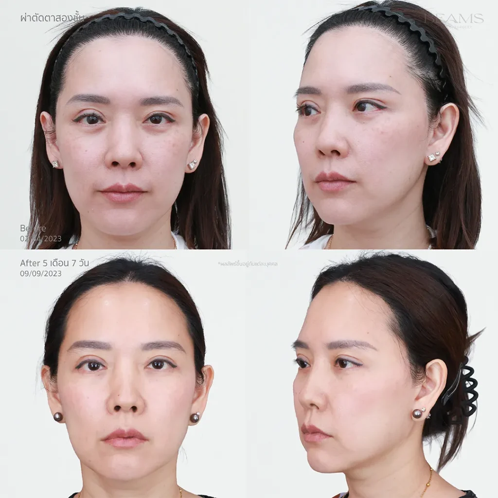 ทำตาสองชั้น รีวิว