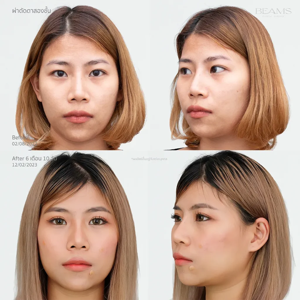 ทำตาสองชั้นที่ Dr.Beam