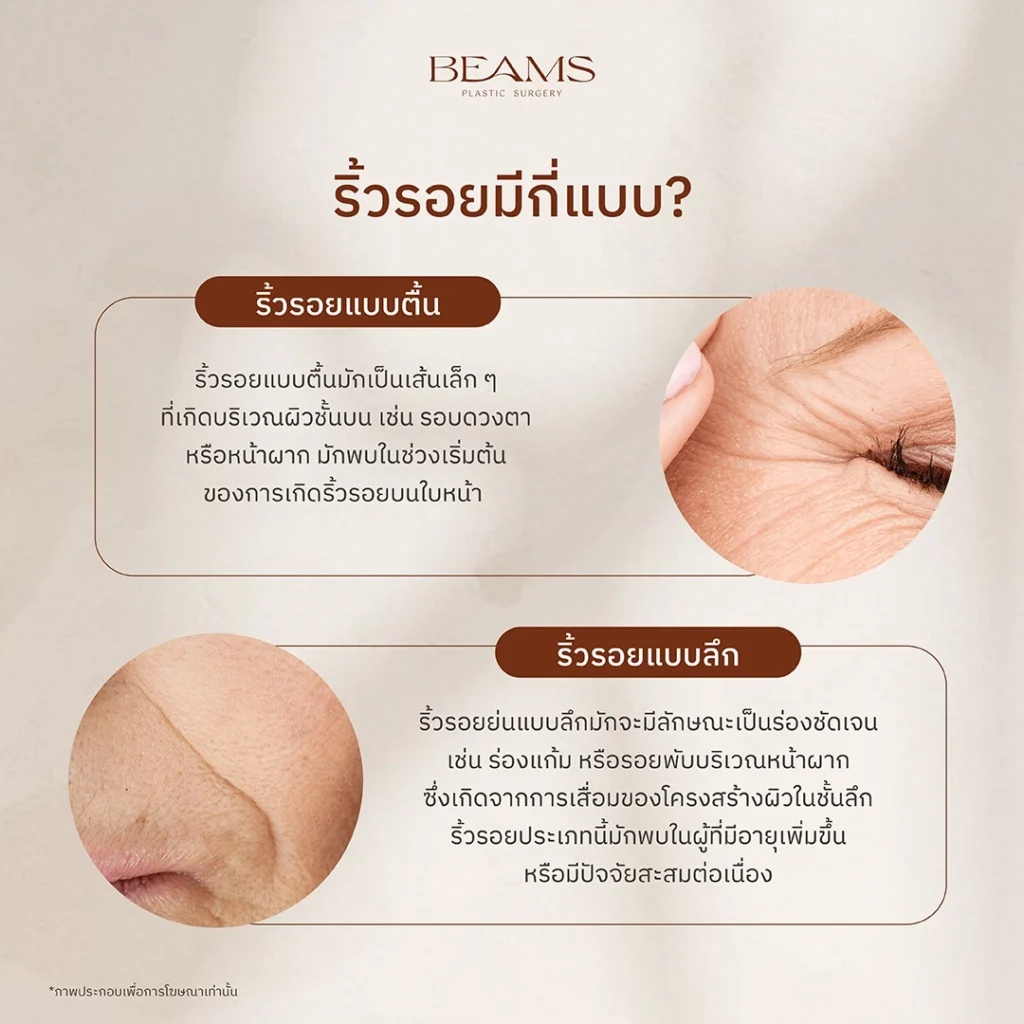 ประเภทของริ้วรอย