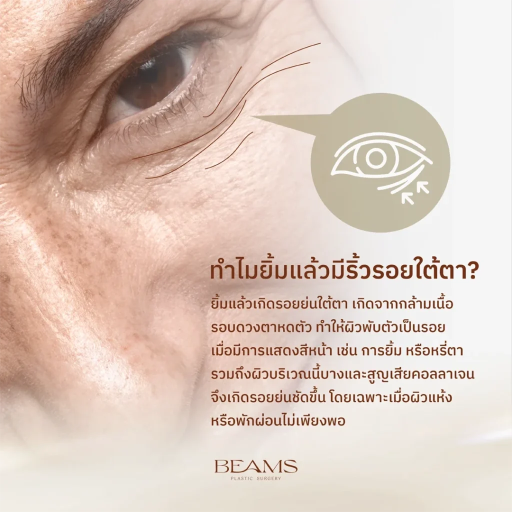 รอยขีดใต้ตา