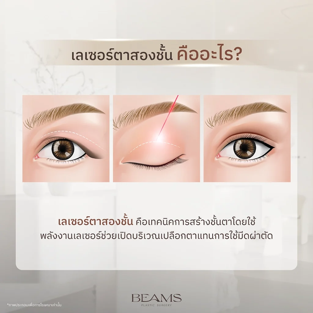 เลเซอร์ตาสองชั้น คืออะไร