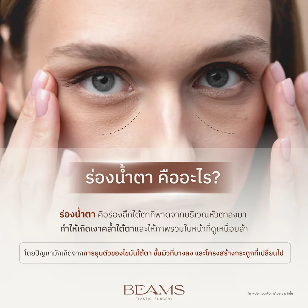 ร่องน้ำตาคืออะไร