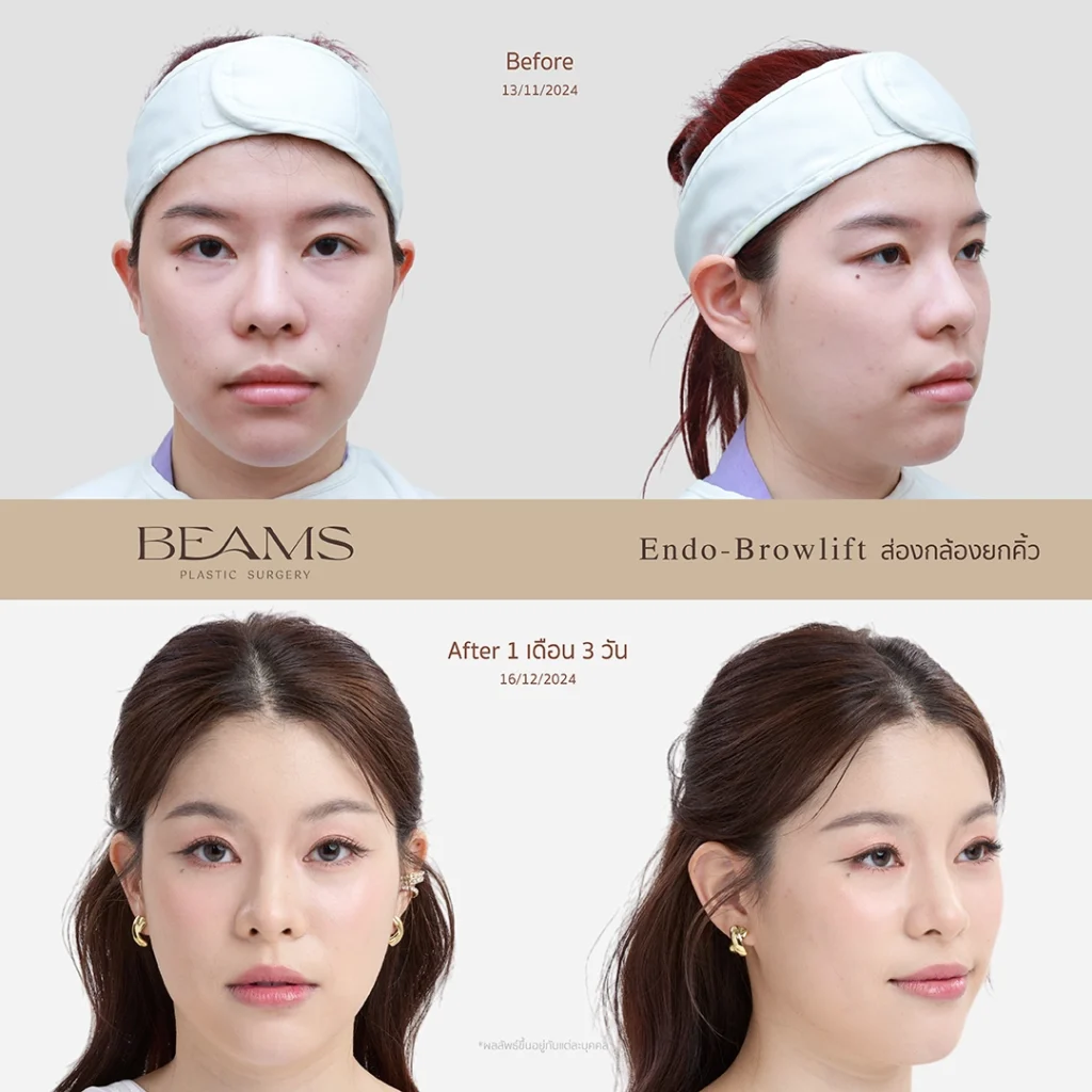 รีวิวยกคิ้วส่องกล้อง