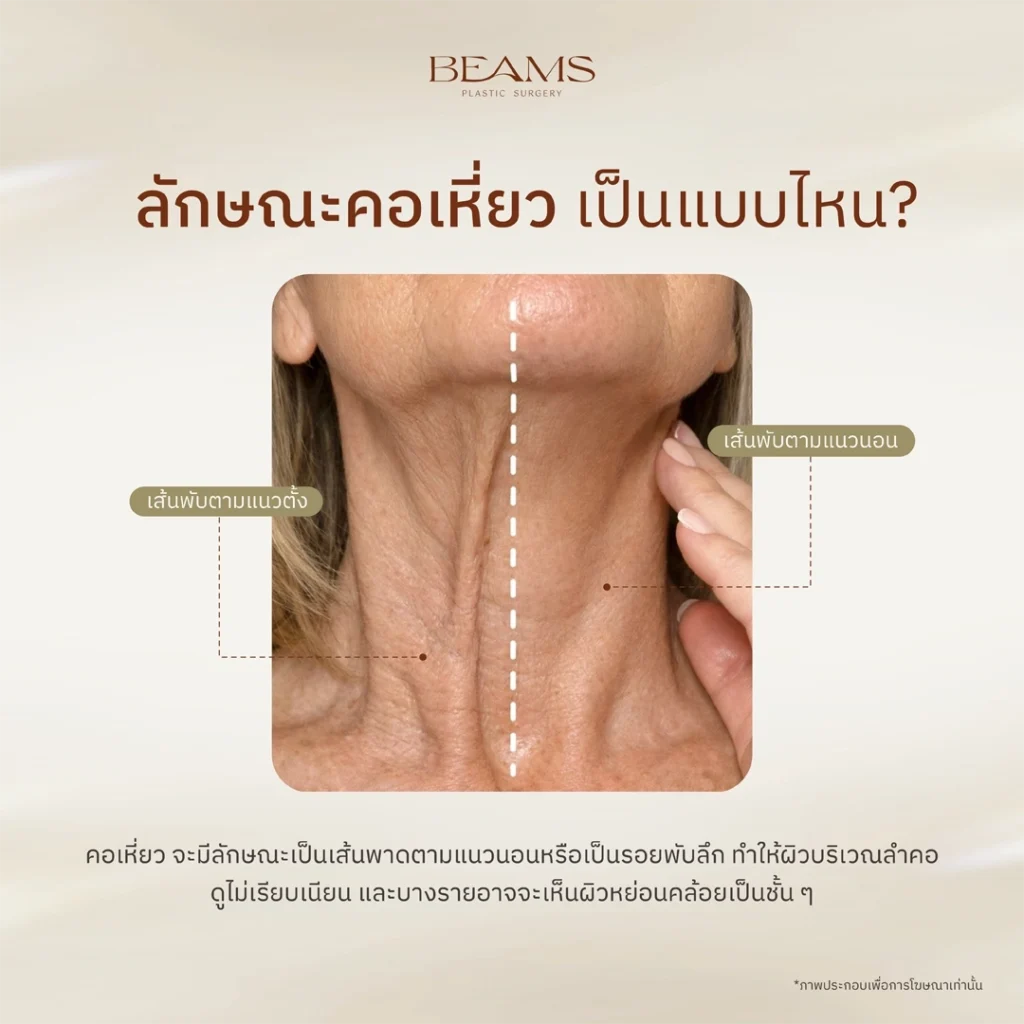 ลักษณะคอเหี่ยว