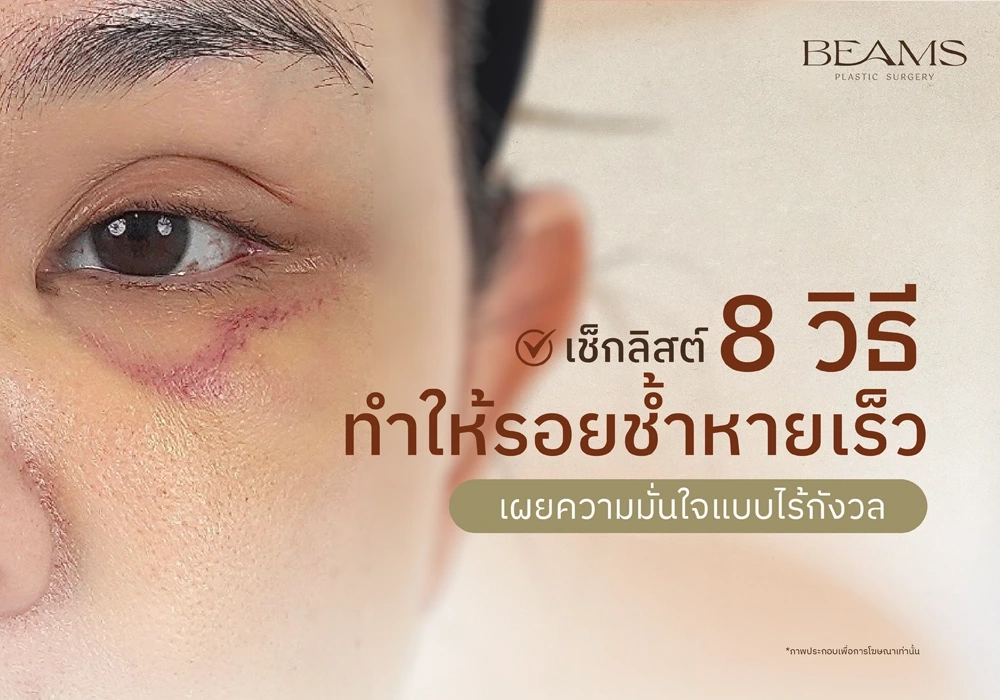 วิธีทำให้รอยช้ำหายเร็ว