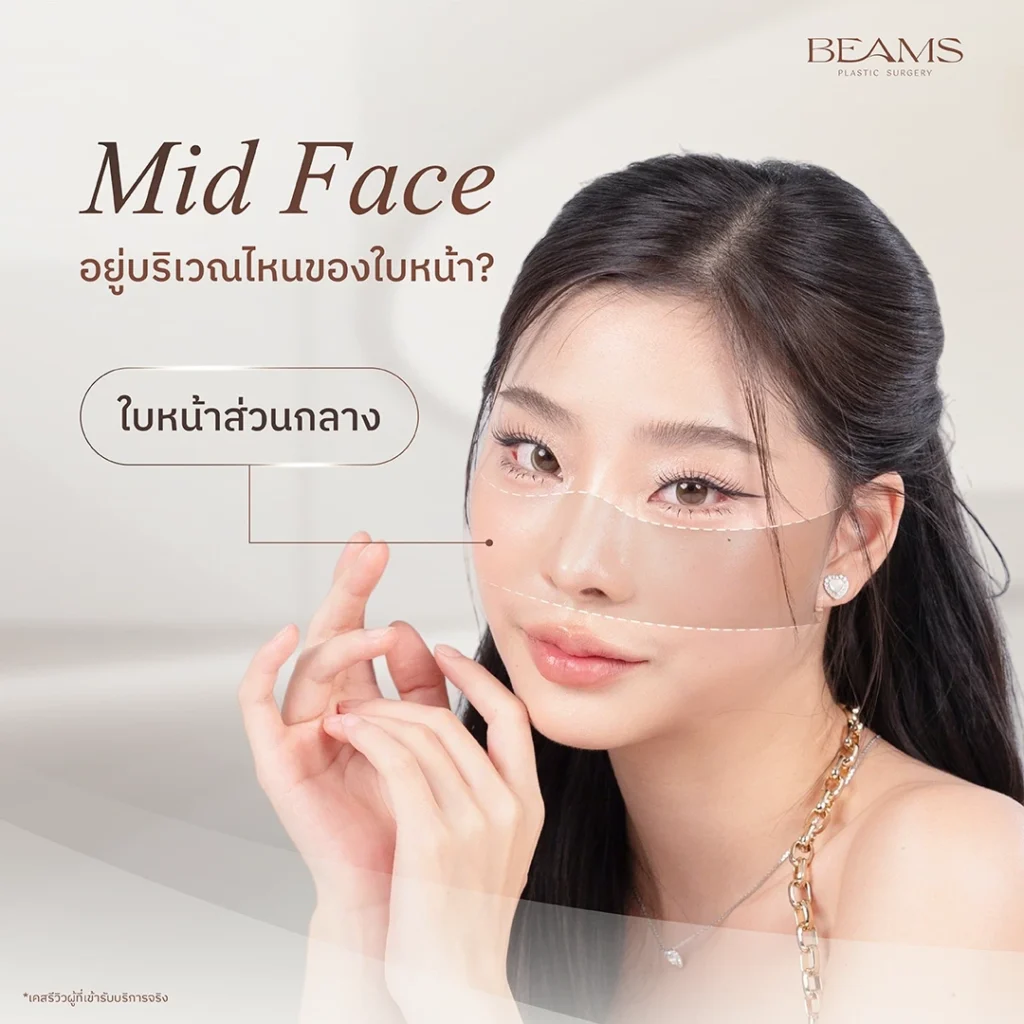 ตำแหน่ง Midface