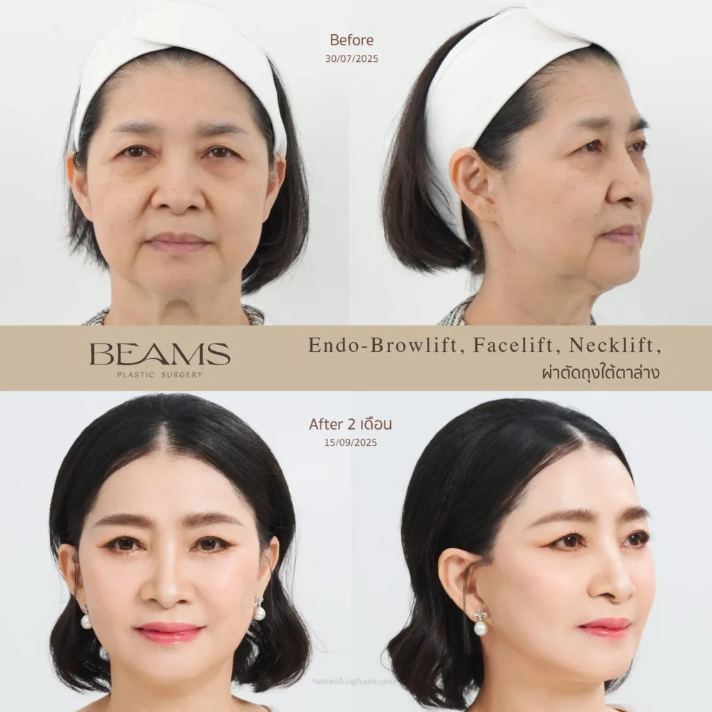 รีวิวยกกระชับคอ
