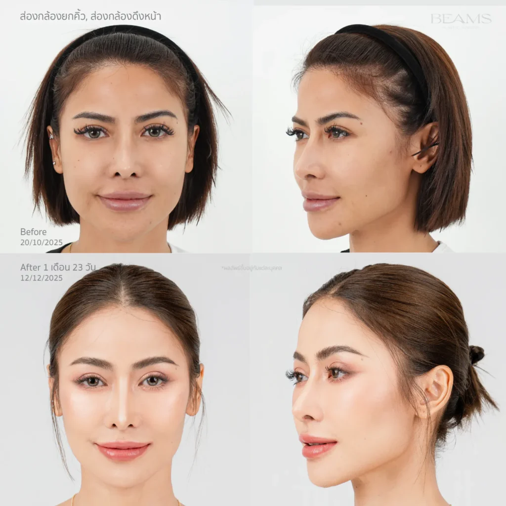 รีวิวยกคิ้วส่องกล้อง