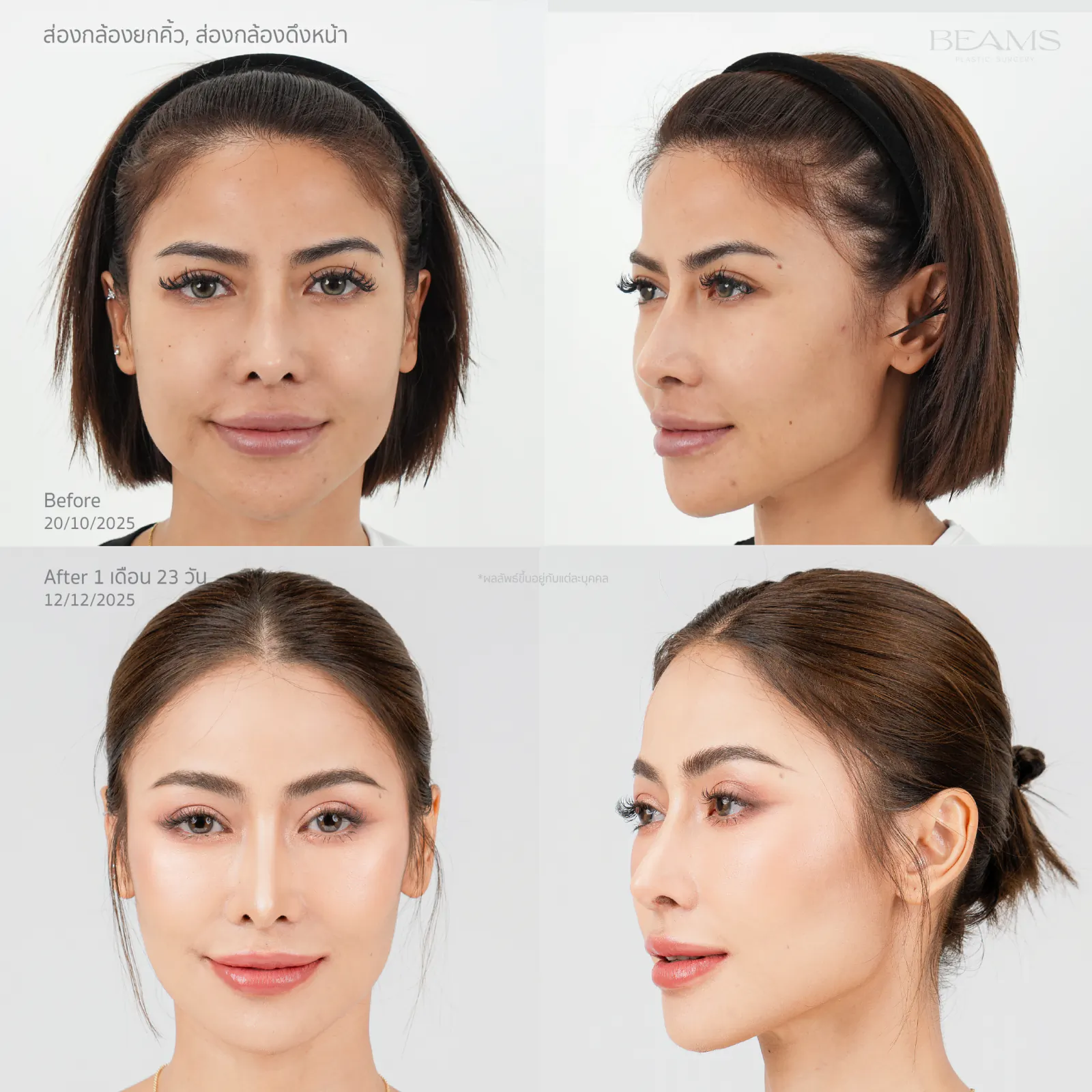 รีวิวยกคิ้วส่องกล้อง