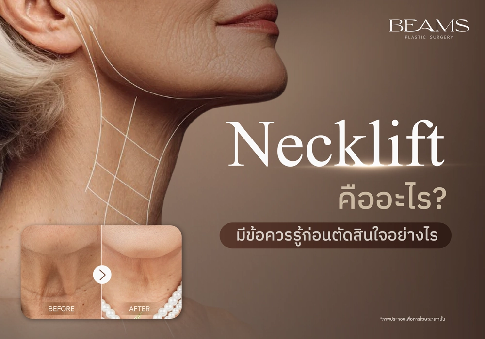 Necklift คืออะไร
