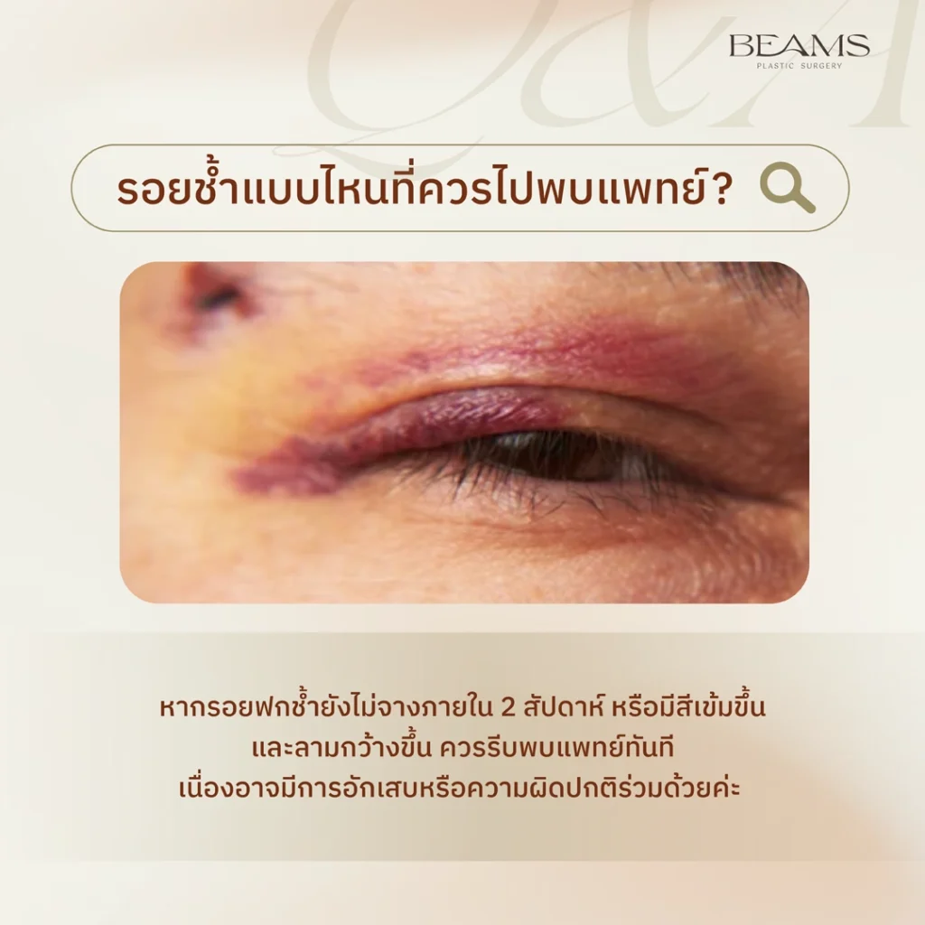 รอยช้ำแบบไหนควรพบแพทย์