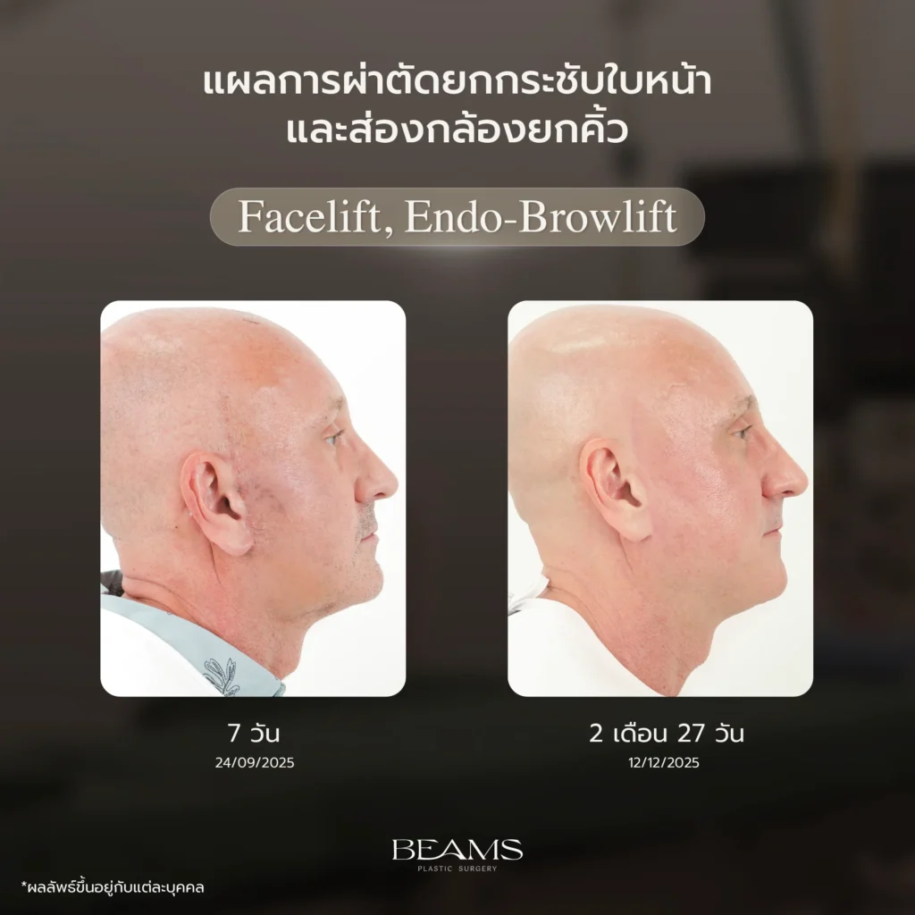 แผลหลังศัลยกรรมบวมน้อย