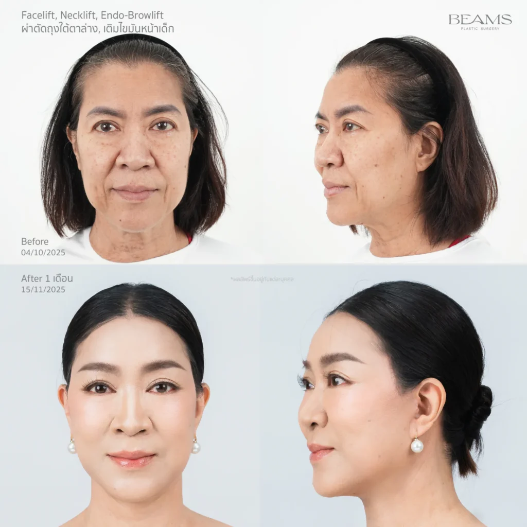 รีวิวฉีด Baby Fat