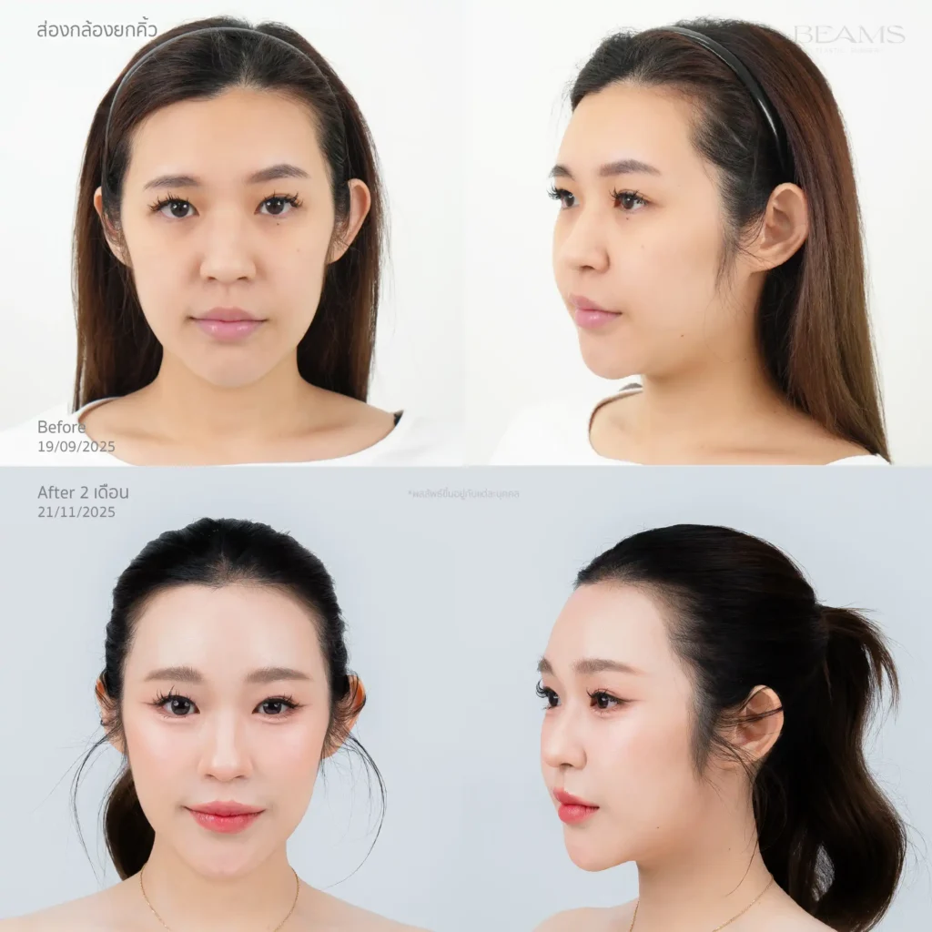 รีวิวยกคิ้ว ราคา