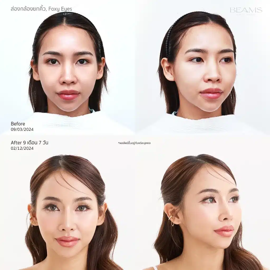 รีวิวยกคิ้ว ราคาเท่าไหร่