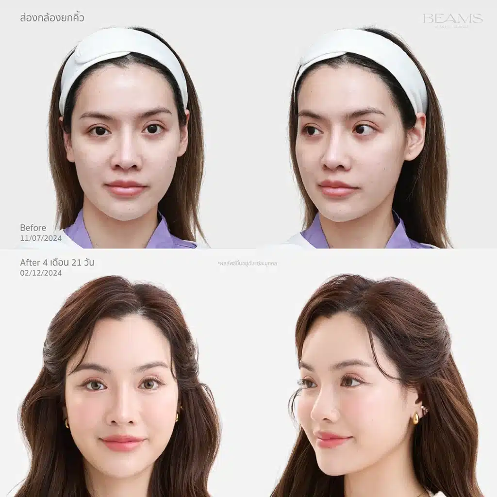 รีวิวยกคิ้ว