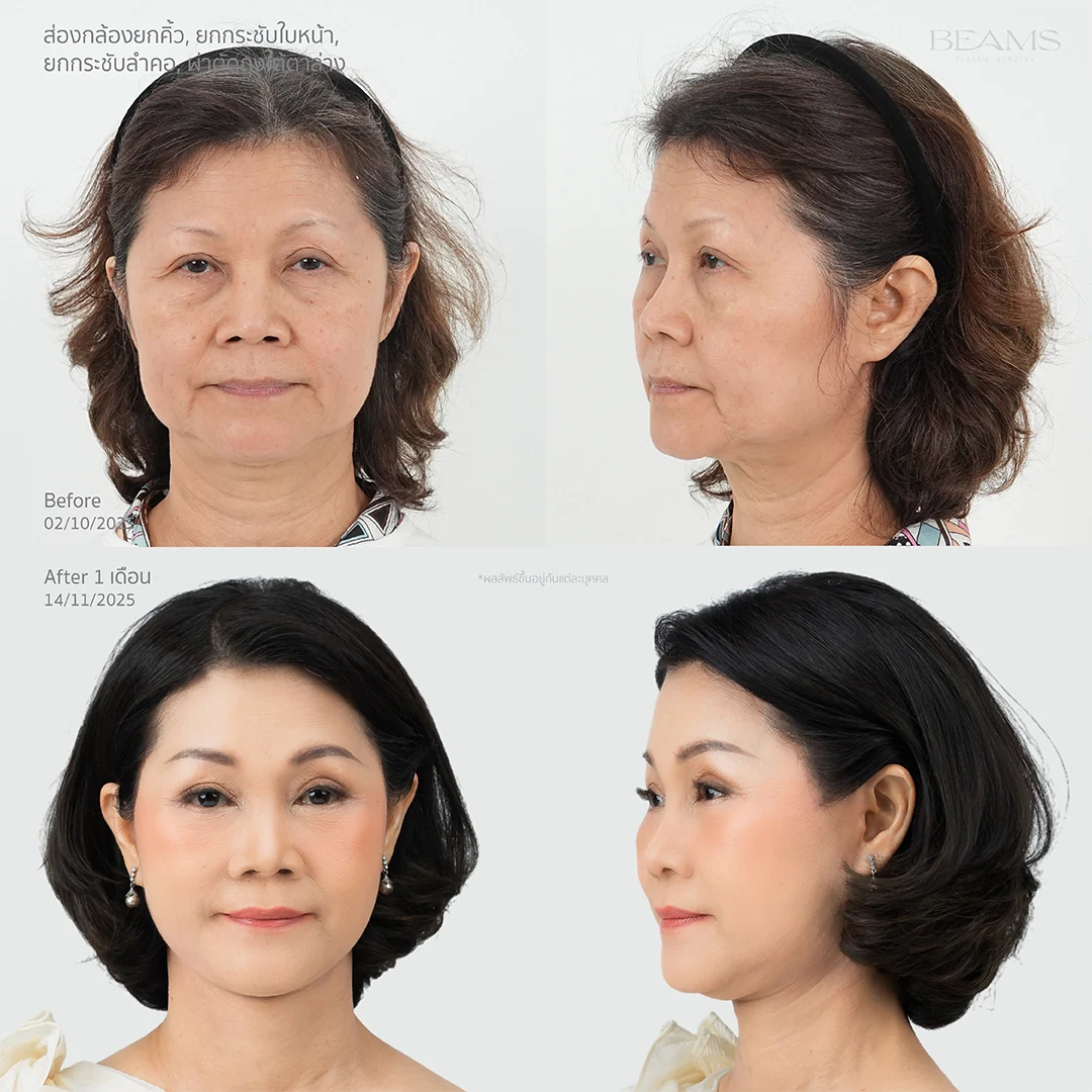 รีวิวดึงหน้า ยกคิ้วส่องกล้อง และแก้ปัญหาใต้ตา