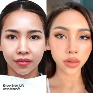 รีวิว แก้คิ้วตก ตาตก ส่องกล้องยกคิ้ว (ENDO-BROW LIFT)