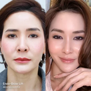 รีวิว แก้คิ้วตก ตาตก ส่องกล้องยกคิ้ว (ENDO-BROW LIFT)