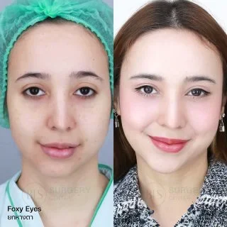 รีวิว ดึงหน้า แก้หน้าหย่อนคล้อย (FACELIFT)