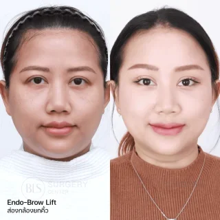 รีวิว ดึงหน้า แก้หน้าหย่อนคล้อย (FACELIFT)