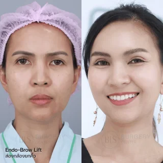 รีวิว ดึงหน้า แก้หน้าหย่อนคล้อย (FACELIFT)