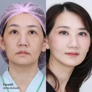 รีวิว ดึงหน้า แก้หน้าหย่อนคล้อย (FACELIFT)