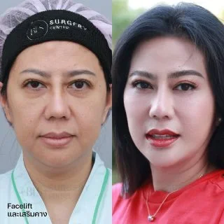 รีวิว ดึงหน้า แก้หน้าหย่อนคล้อย (FACELIFT)